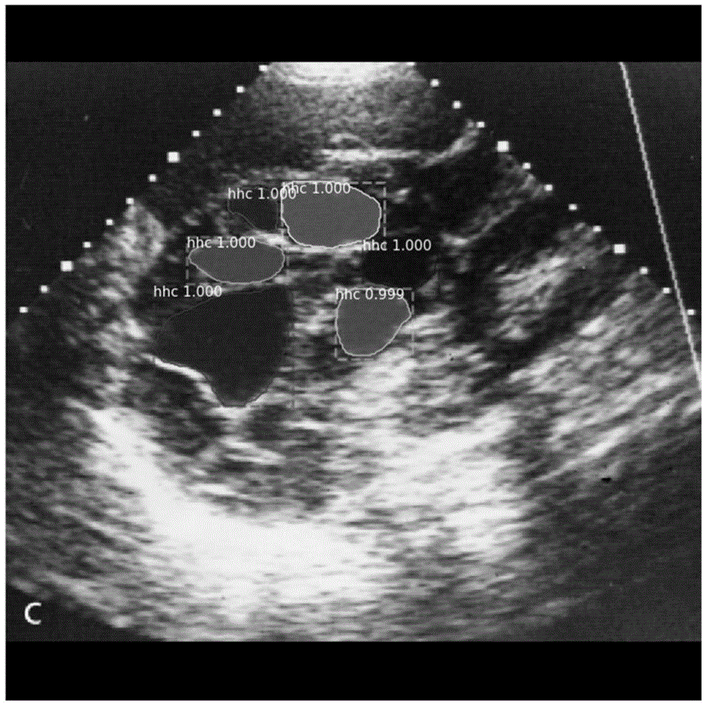 肝包虫超声ai辅助诊断方法及系统与流程