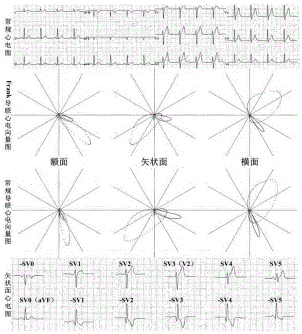 心电图导联向量图片图片