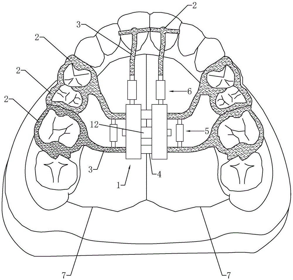 导弓式矫治器制作方法图片