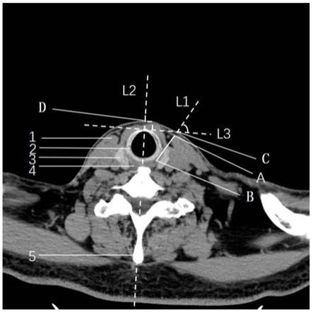 一種基於頸部ct掃描影像的環嚥肌經皮定位方法