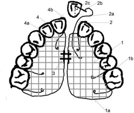 上頜中切牙倒置阻生的弧形牽引絲活動矯治器的製作方法