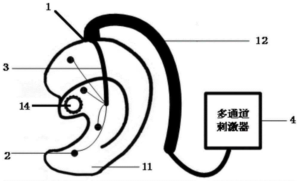 一種耳塞式耳穴電極刺激裝置