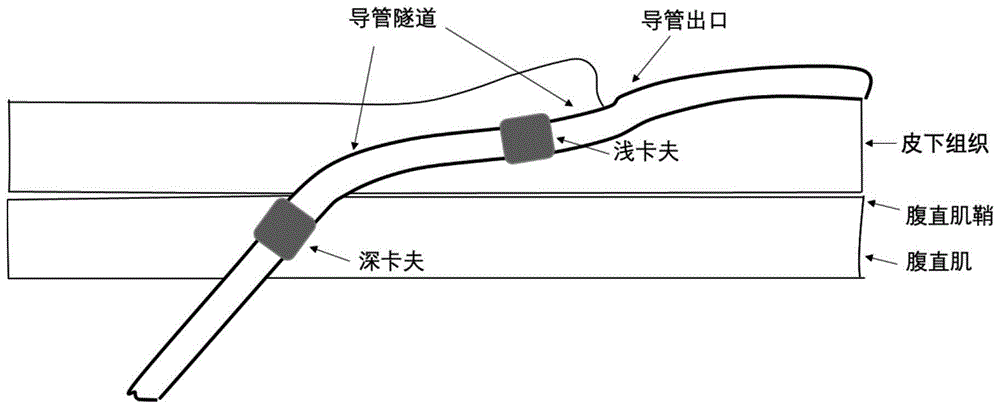 一种带卡夫的医疗导管的制作方法