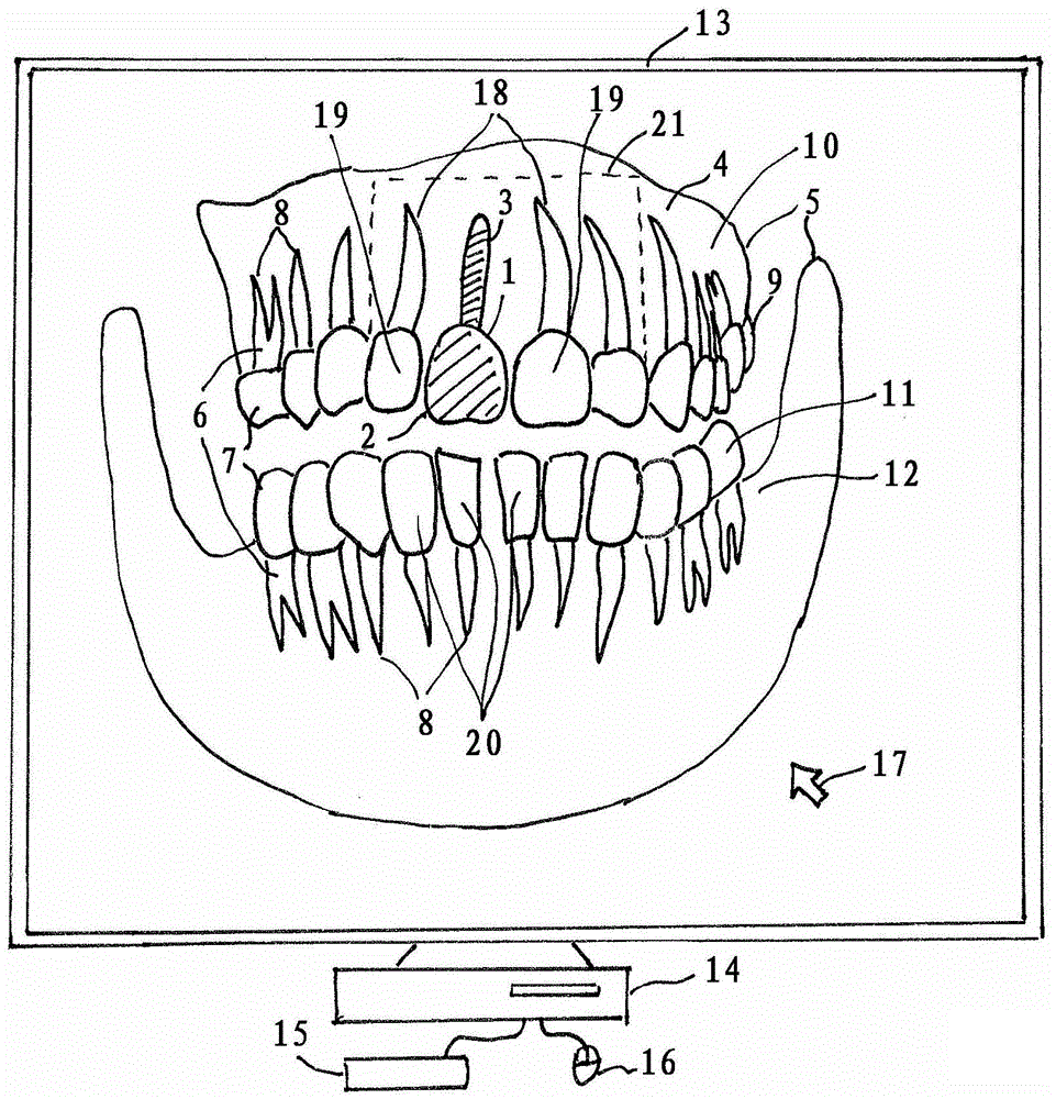用於創建牙齒狀況的圖形表示的方法與流程