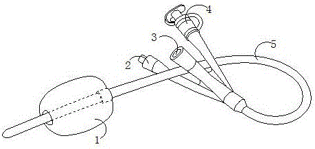 背景技術:三腔導尿管有三個腔,一個用於引流膀胱內尿液,一個用於向