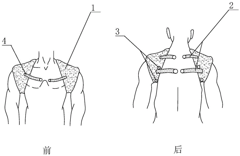 锁骨骨折用骨折复位固定装置的制作方法