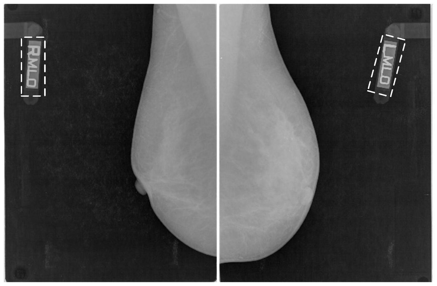 一種魯棒性乳腺鉬靶mlo視角圖像胸肌分割方法