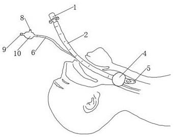 气切插管原理图图片