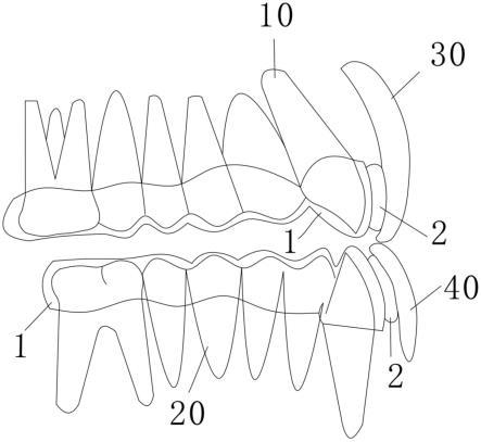 一种牙齿矫治器的制作方法
