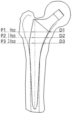 髋关节假体股骨柄系统的制作方法