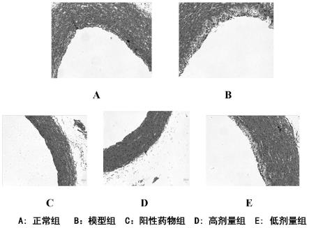 一种用于治疗冠心病及动脉粥样硬化的傣医药组方