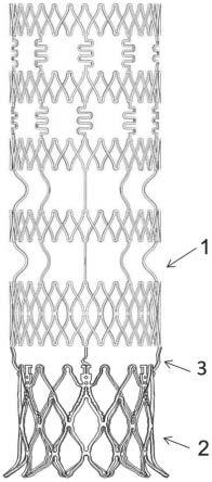 血管支架的制作方法