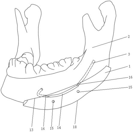 下颌骨神经指引划线保护截骨导板的制作方法