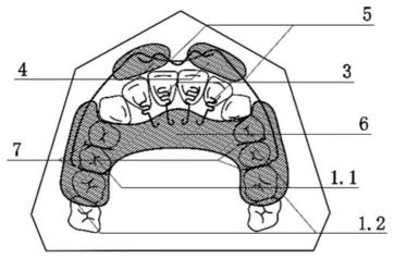 可治疗前牙反咬合的上颌牙合垫唇挡矫治装置