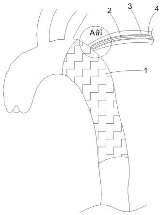 组装式主动脉腔内支架及左锁骨下动脉原位开窗系统及方法与流程