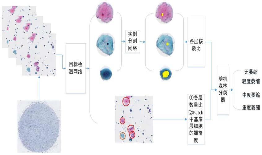 宫颈细胞萎缩级别智能诊断方法