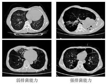 一种基于CT图像分析的肺结核排菌能力检测方法及系统与流程