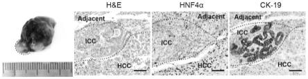 一种肝细胞-胆管细胞混合型肝癌小鼠模型及其构建方法