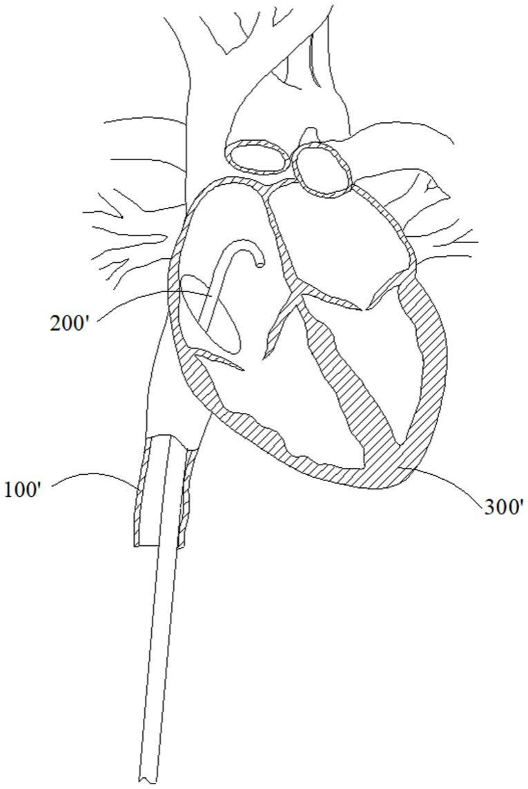 心血管介入治疗器械的输送系统、鞘管及其调弯方法与流程