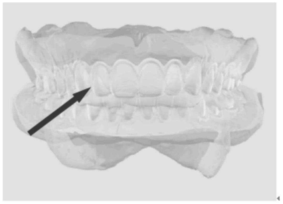 一种成型上颌半口义齿个性化腭图及其方法