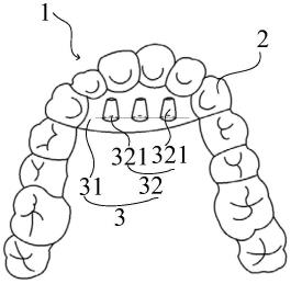 壳状牙齿矫治器的制作方法