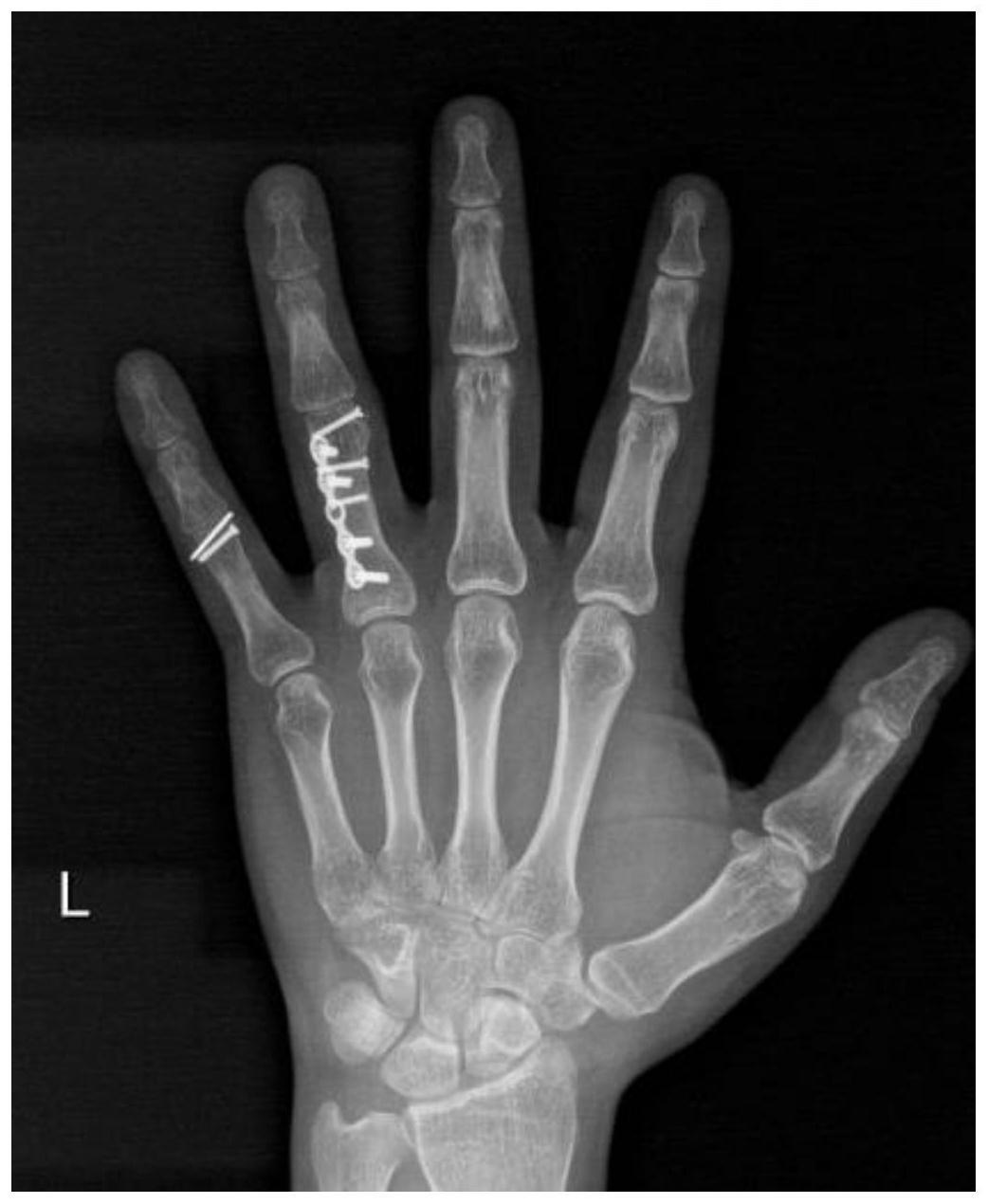 一种完全清醒技术在治疗非骨性指关节僵硬中的应用的制作方法