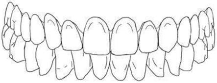 一种用于制作种植术后临时牙的可塑型光固化树脂牙列