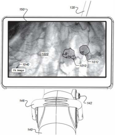 具有一次性插管的便携式人体工程学内窥镜的制作方法