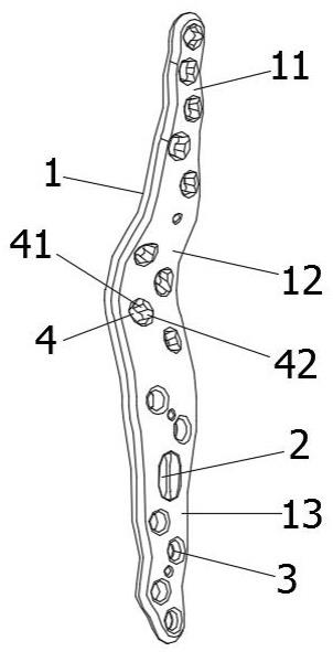 腕骨尺骨掌骨连接板的制作方法