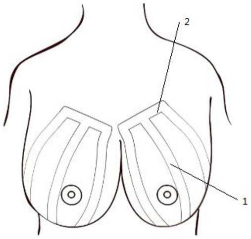 一种用于乳腺提升手术中的乳腺提升带的制作方法