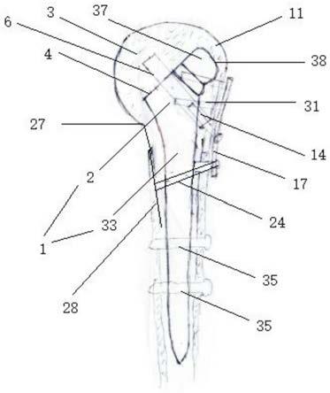 一种用于肱骨近端骨折的修复装置的制作方法