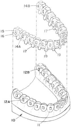 牙齿定位器具及其制造及使用系统及方法与流程