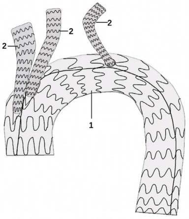 主动脉弓离断分型图片