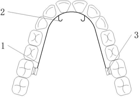 一种用于上牙列整体远移的腭侧正畸装置