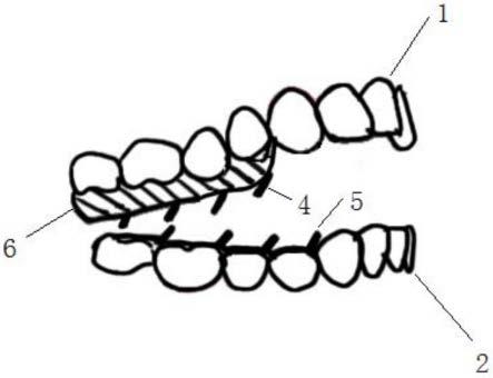舌力咬合力介导的隐形矫治装置