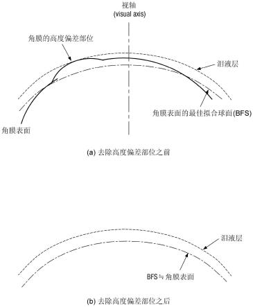 用于治疗干眼症的激光角膜切削系统及方法与流程