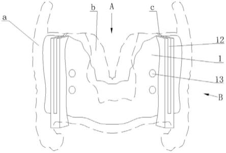 喉部软骨病变部位截骨导板的制作方法