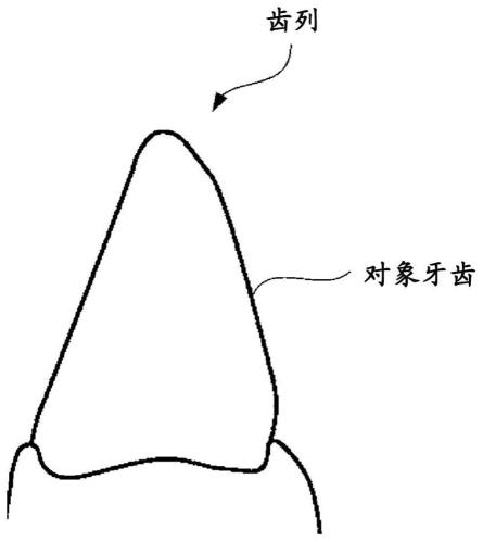 齿列矫正器具的提供方法与流程