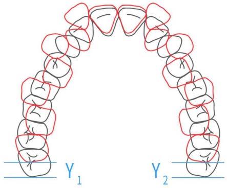 一种同步测量牙齿拥挤度及整平Spee曲线所需间隙的方法与流程