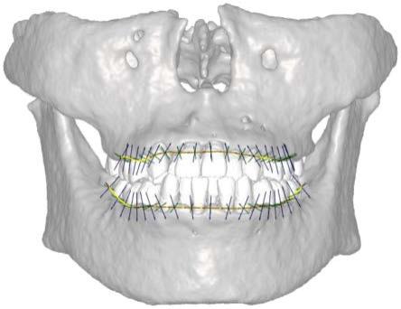 基于牙槽几何形态的牙槽弓坐标系统构建方法及其应用与流程