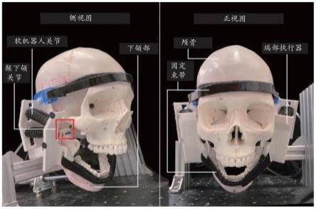 用于颞下颌关节紊乱康复的软外骨骼可穿戴设备