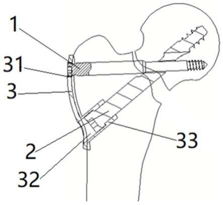 股骨颈动态三角支撑系统的制作方法