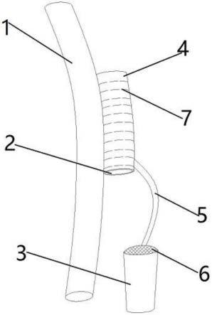一种带牙垫固定装置的气管插管的制作方法