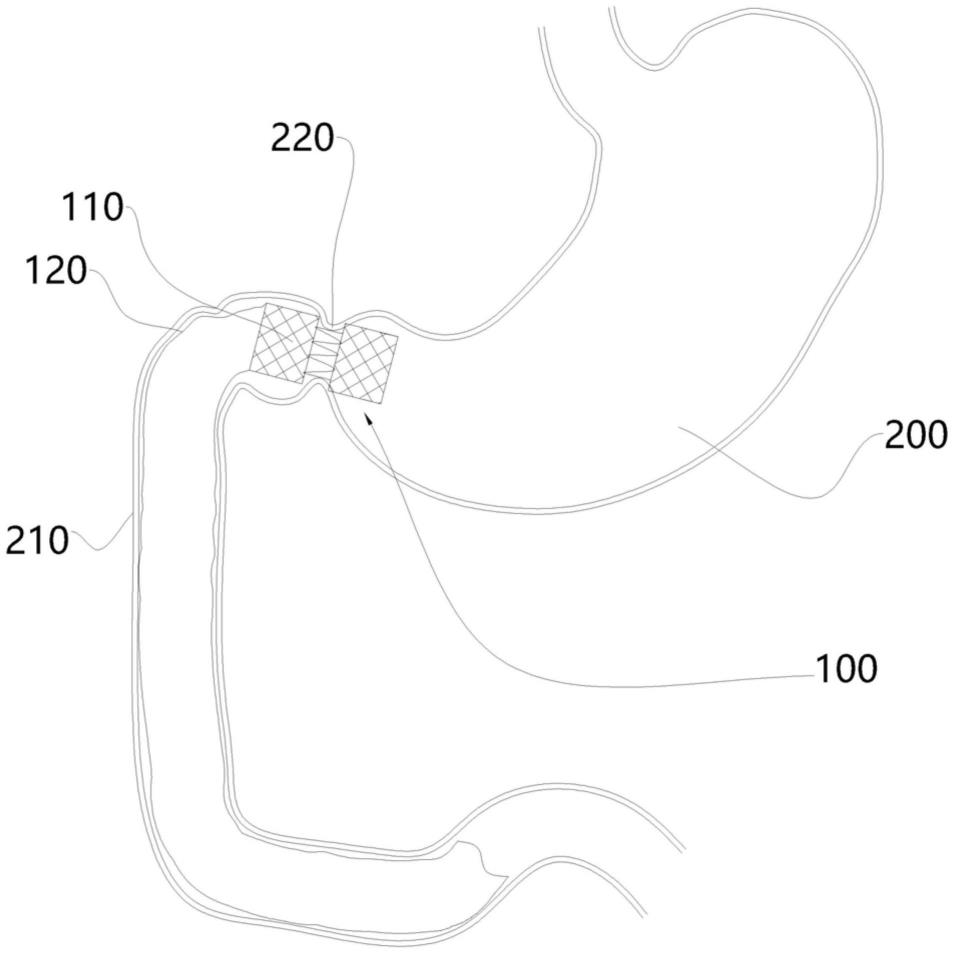 肠道防吸收器置入装置的制作方法