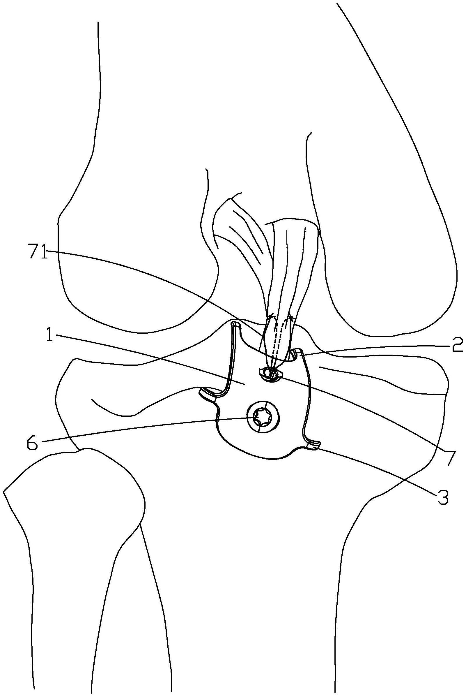 一种胫骨后交叉韧带止点撕脱骨折锁定板及持板器的制作方法