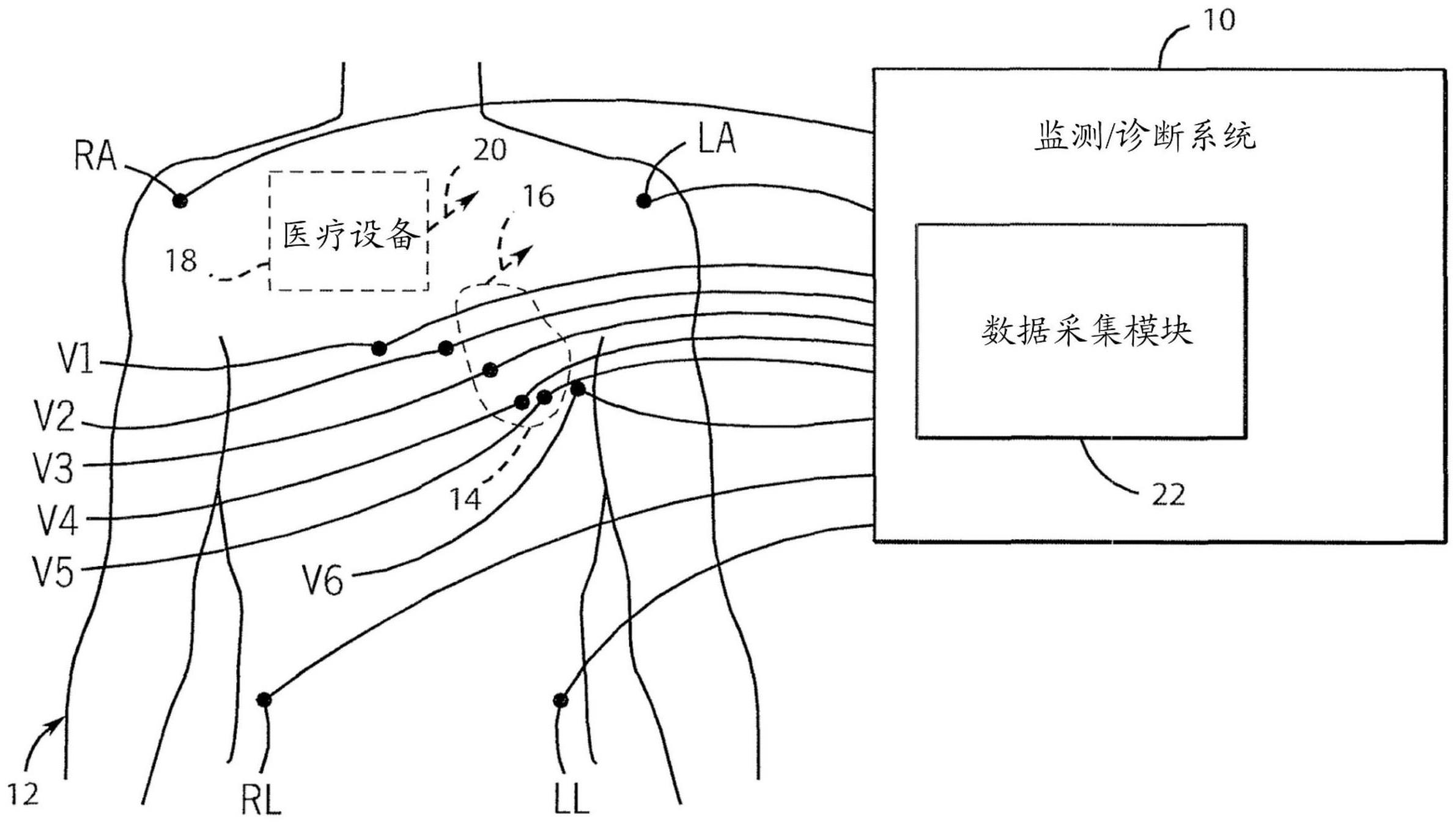 用于心电图的串行比较的系统的制作方法