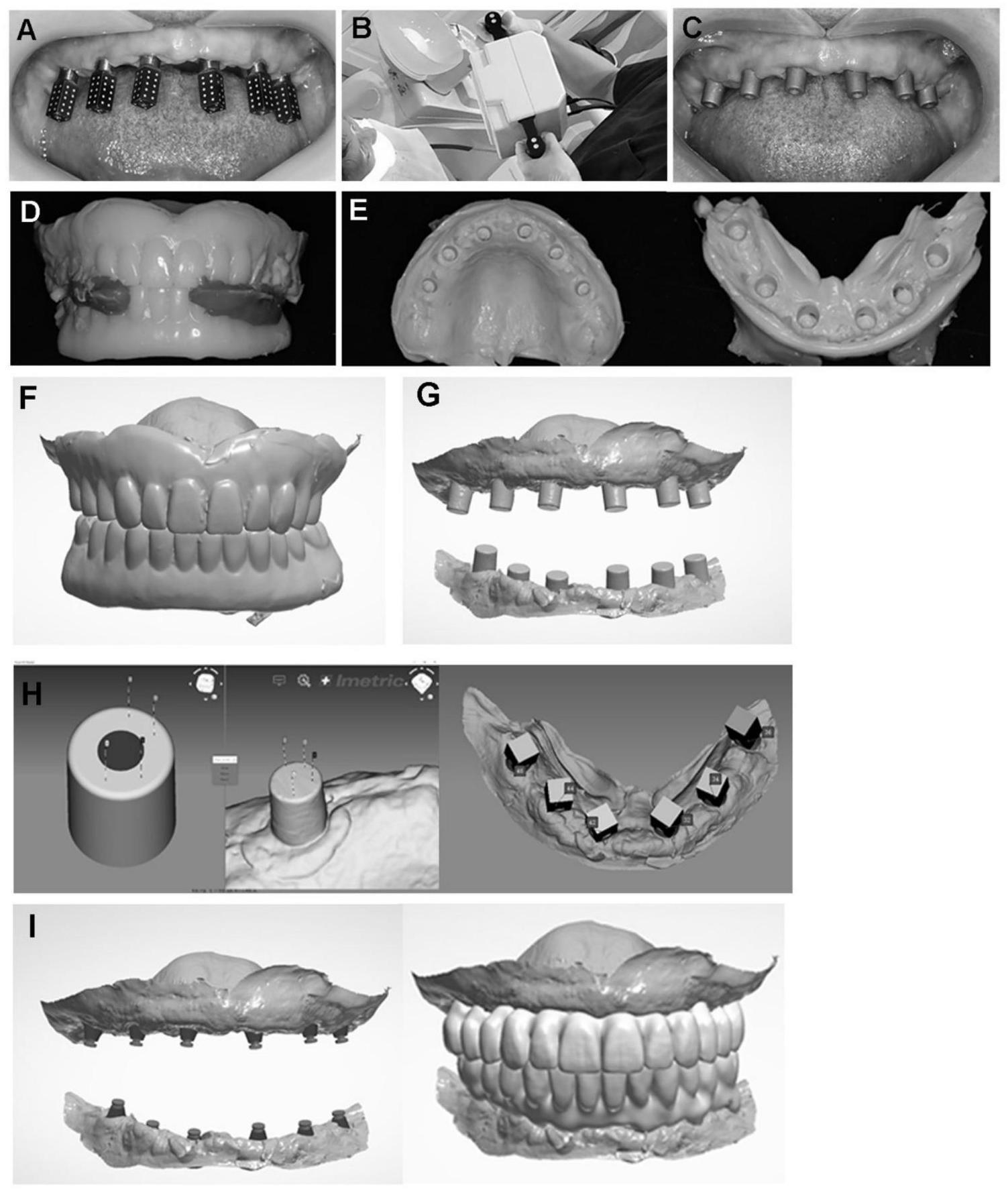 一种基于摄影测量技术的数字化无牙颌种植即刻修复方法与流程