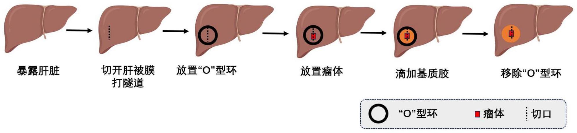 用于构建小鼠肝癌原位移植模型的试剂盒