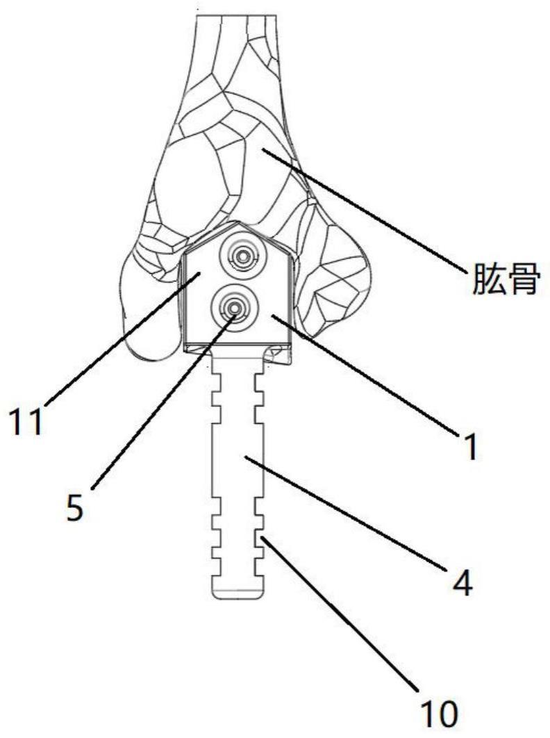 一种肘关节骨导板的制作方法