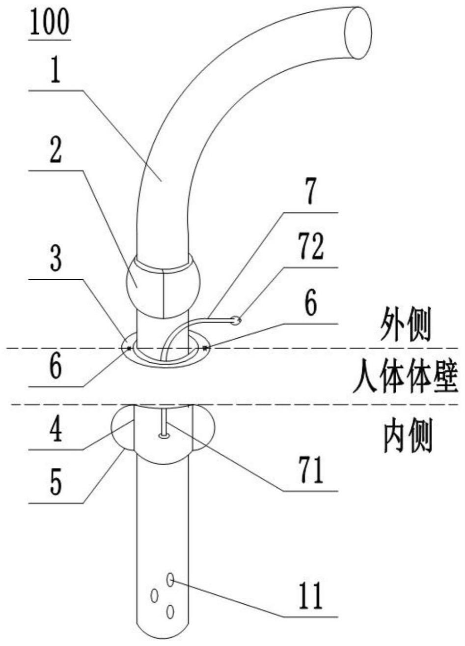 一种免缝合